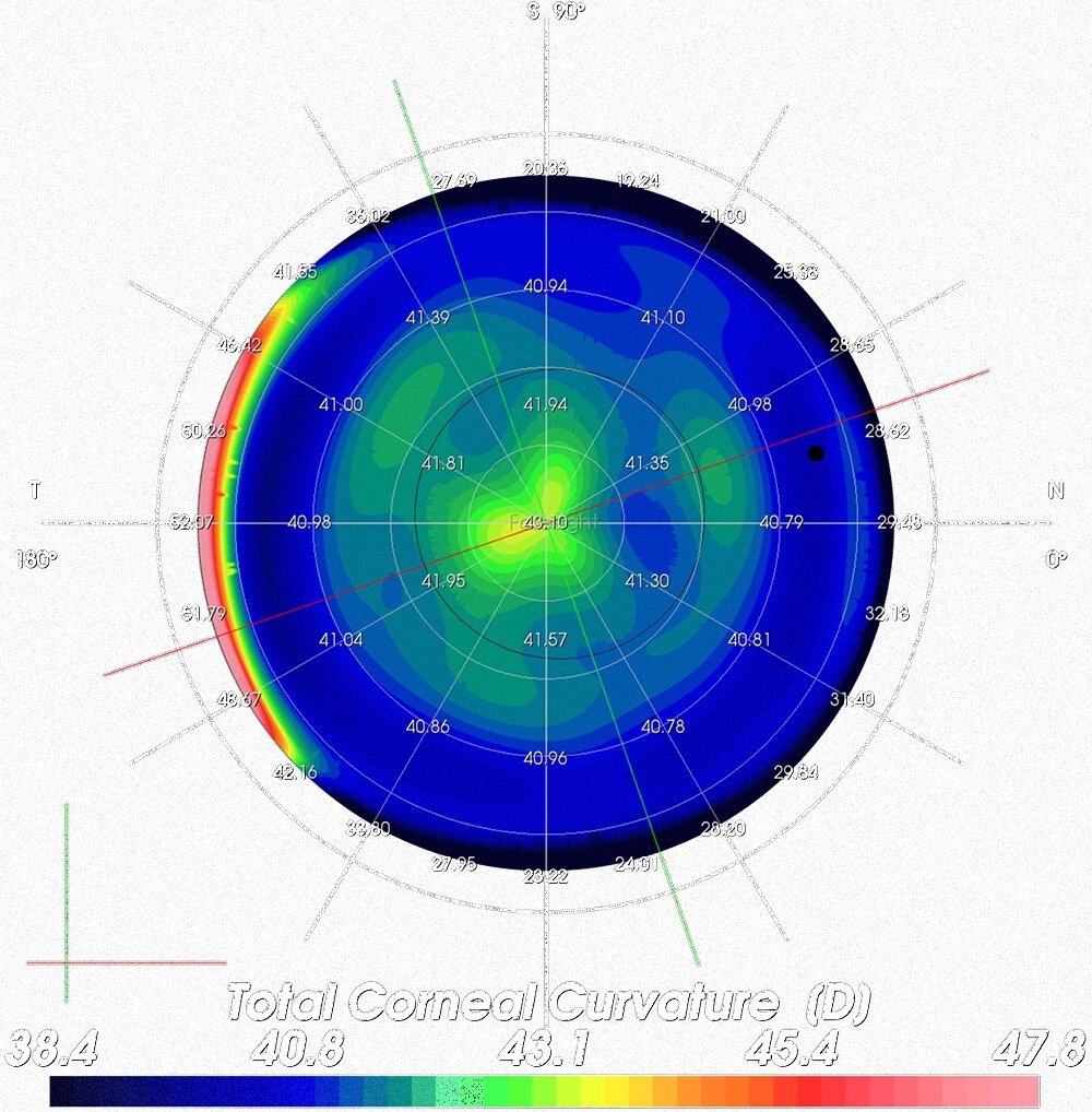 Visualisation post-operative simulated outcome (SCHWIND MS-39) 