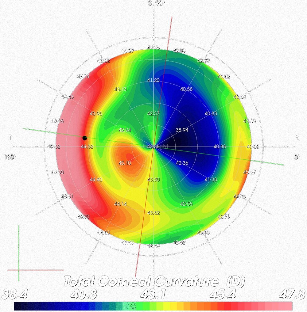 Visualisation Pre-operative total corneal curvature (simulation SCHWIND MS-39) 